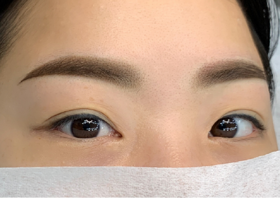 眉の施術例